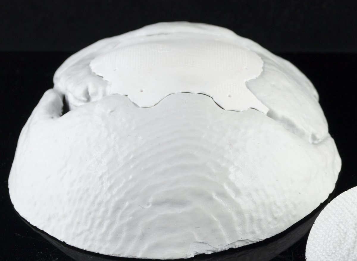 Patient-specific cranial plate in technical ceramic